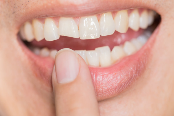 Cracked And Chipped Teeth Treatment