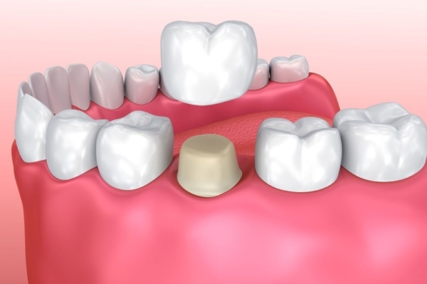 Dental Crowns And Bridges