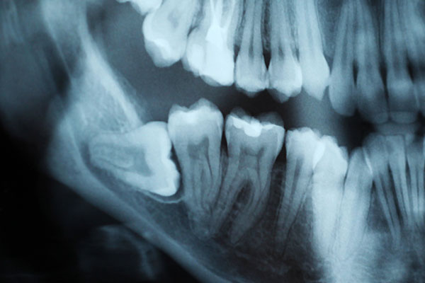 Impacted Wisdom Teeth Treatment